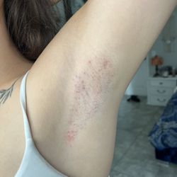 Couture Med Spa - Laser burn