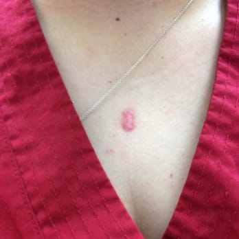 Romantic Torture Tattoo & Piercing - My scar from a surface piercing gone wrong - Tattoo Near Me - Raleigh, North Carolina Romantic Torture Tattoo & Piercing - My scar from a surface piercing gone wrong - Tattoo Near Me - Raleigh, North Carolina