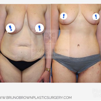 Bruno Brown Plastic Surgery - Mommy makeover with tummy tuck and breast lift - Medical Spas Near Me - Chevy Chase, Maryland
