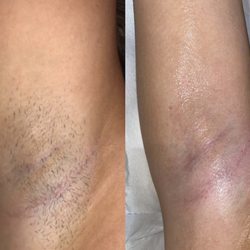 Hair removal by Silvia Ortiz - First and fifth session!!