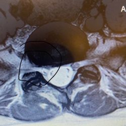 Big Oak Radiology - Herniated disc
