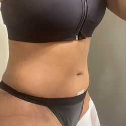 Sinno Center for Plastic Surgery - 2weeks post op