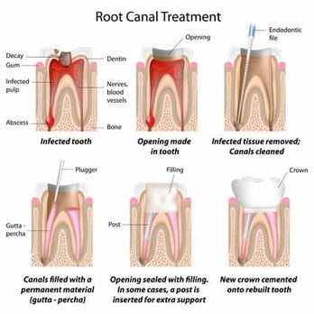 Marc Lippas, DDS - Root canal treatments - which can remove the infected pulp and nerve tissue from inside your tooth - can save your tooth and your smile. - Cosmetic Dentists Near Me - Dallas, Texas Marc Lippas, DDS - Root canal treatments - which can remove the infected pulp and nerve tissue from inside your tooth - can save your tooth and your smile. - Cosmetic Dentists Near Me - Dallas, Texas