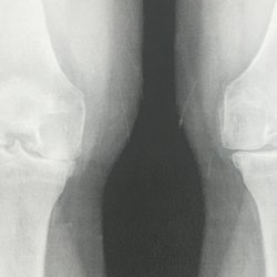 Kitziger Kurt MD - The old crushed, bone on bone, painful bowed knees.