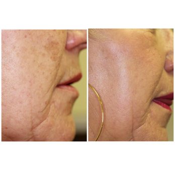 DeLorenzi Clinic - BBL one month post for pigmentation - Cosmetic Surgeons Near Me - Kitchener, Ontario DeLorenzi Clinic - BBL one month post for pigmentation - Cosmetic Surgeons Near Me - Kitchener, Ontario