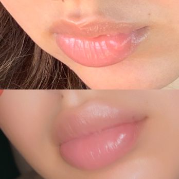 Dolce Aesthetics - Before photo- botched by another clinic, left with a bump After photo- Dr.Jenn was able to help camouflage the uneven volume in my lips!! - Medical Spas Near Me - Queens, New York