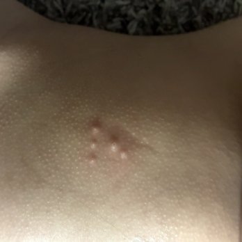 SpringHill Suites by Marriott Houston NASA/Webster - Bed bug bites in 1yr old - Hotels Near Me - Webster, Texas SpringHill Suites by Marriott Houston NASA/Webster - Bed bug bites in 1yr old - Hotels Near Me - Webster, Texas