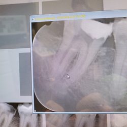 Chestnut Hill Endodontics, LLC - Broken file just the the left of the cursor