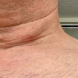 Anthony N Dardano, DO, FACS - Sagging Pocket Of Skin
