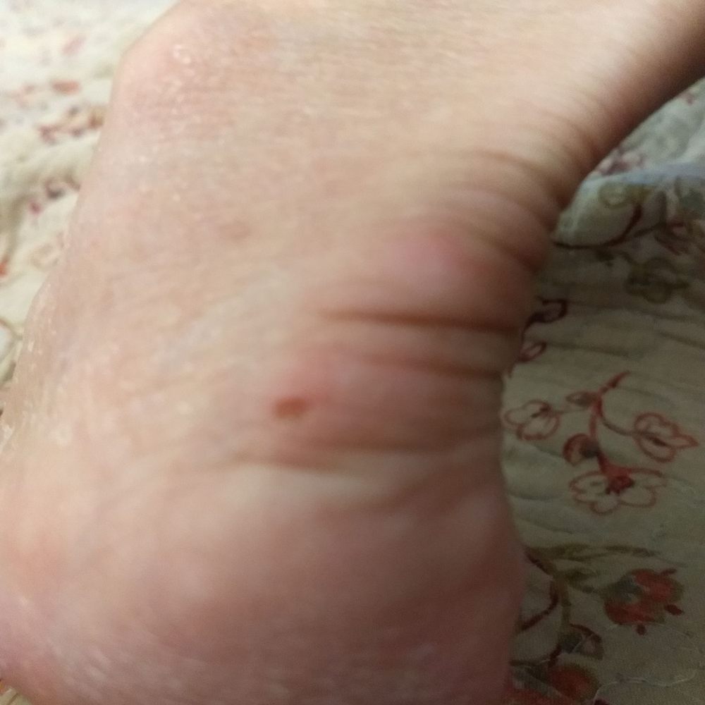 Scraped the skin off my heal