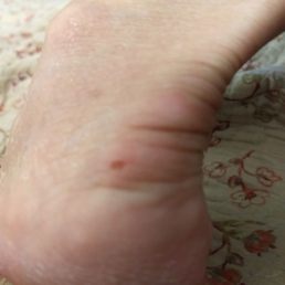 Scraped the skin off my heal Scraped the skin off my heal