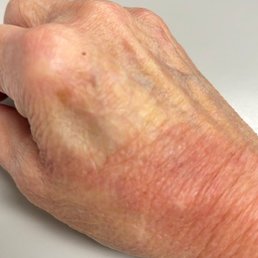 Scalded skin from my thumb area across my hand and wrist Scalded skin from my thumb area across my hand and wrist