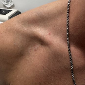 MS Slim - After 13 treatments - Skin Care Near Me - Irvine, California MS Slim - After 13 treatments - Skin Care Near Me - Irvine, California