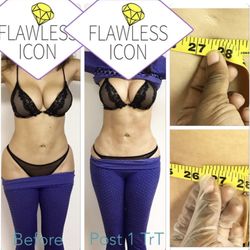 Flawless Icon - Laser Lipo most of our Icons Fav. Melt fat/ Tighten Skin. No down time view @lasermepleasemiami for gallery.