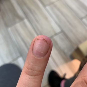 D J Nails - Torn nail - Nail Salons Near Me - Mesquite, Texas D J Nails - Torn nail - Nail Salons Near Me - Mesquite, Texas
