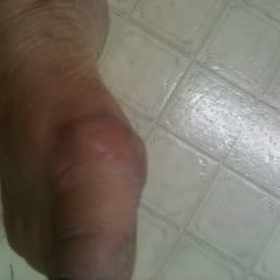 One of the pictures of the ulcer. Taken yesterday almost a month later