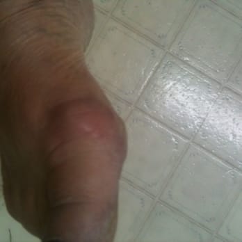 Nj Nails and Spa - One of the pictures of the ulcer. Taken yesterday almost a month later - Nail Salons Near Me - Ocala, Florida
