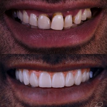 Davis Dental - New teeth in one day with All-on-X dental implants - Cosmetic Dentists Near Me - Bountiful, Utah Davis Dental - New teeth in one day with All-on-X dental implants - Cosmetic Dentists Near Me - Bountiful, Utah