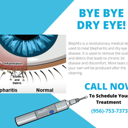 Flores Eye Care Clinic - Say BYE BYE DRY EYES! Don't wait until it's too late. Schedule your BlephEx TODAY! Call (956)-753-7373