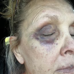 24 hours following procedure
