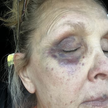 Precision M.D. Cosmetic Surgery Center - 24 hours following procedure - Skin Care Near Me - Elk Grove, California