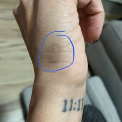 Sophie Shirin, MD - Side of my had indicating the scar and dark spot.
