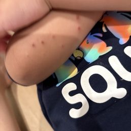 This we just one part of his body he had it everywhere my poor 2 years old This we just one part of his body he had it everywhere my poor 2 years old