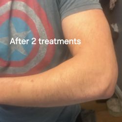 Laser Smooth - Laser hair removal on arms, after 2nd treatment