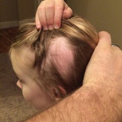Adventures Unlimited - Bald spot due to hair being ripped out while in care of Adventures Unlimited Daycare, Salem Oregon.