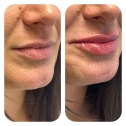 Advanced Skin Renewal - Restylane Kysse@. Aesthetically Natural!