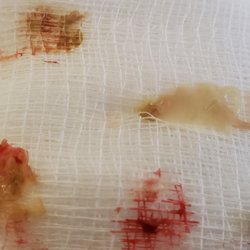 Vetter Steven M, MD - Bone fragments from a prior ENT's surgery removed by Dr Vetter that had harbored a sinus infection for 2 1/2 years.