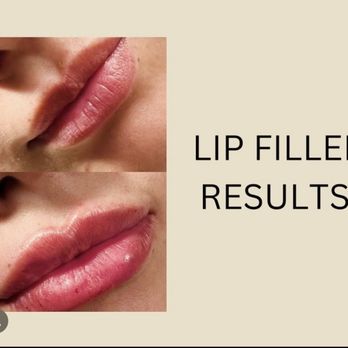 J W Aesthetic - Lip filler - Aestheticians Near Me