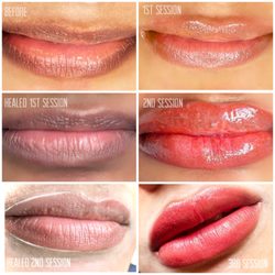 Naperville Beauty Bar - Lip neutralization process, instant results are not possible! This was three sessions 6-8 weeks apart