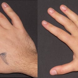 Atlanta Tattoo Removal