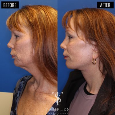 Facelift - Dr. Tamplen has quickly become the Bay areas leading face and neck-lifting surgeon. He takes the time to perfect the surgical plan and approach with every individual patient. He will never leave a patient looking to tight or unnatural. He uses his modified extended deep plan approach to achieve the beautiful and elegant results every time. Facelift - Dr. Tamplen has quickly become the Bay areas leading face and neck-lifting surgeon. He takes the time to perfect the surgical plan and approach with every individual patient. He will never leave a patient looking to tight or unnatural. He uses his modified extended deep plan approach to achieve the beautiful and elegant results every time.