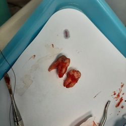 US Dental Group - A wisdom tooth with 2 roots(adnormal) and a large as heck molar that roots go sideways.
