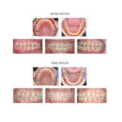 T. Scott Jenkins, DDS - Adolescent with misaligned back teeth (class III) and crowding treated with braces.