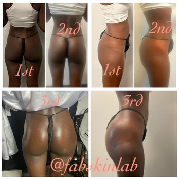 Fab Skin Lab - Vacuum BBL Before and After - Body Contouring Near Me - Upland, California Fab Skin Lab - Vacuum BBL Before and After - Body Contouring Near Me - Upland, California