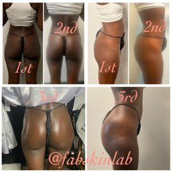 Fab Skin Lab - Vacuum BBL Before and After