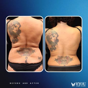 BYou Laser Clinic - Flatbush - Trusclpt - Body Contouring - Back - Skin Care Near Me - Brooklyn, New York BYou Laser Clinic - Flatbush - Trusclpt - Body Contouring - Back - Skin Care Near Me - Brooklyn, New York