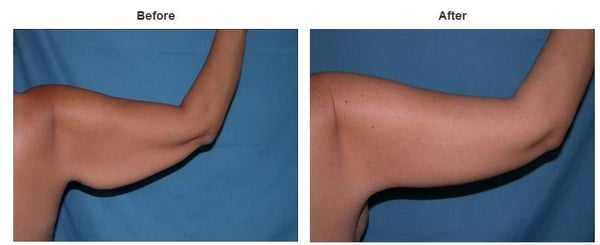 Photo of Suzanne Quardt MD - Palm Desert Plastic Surgery - Rancho Mirage, CA, US. Plastic Surgery Before & After Pictures https://palmdesertplasticsurgery.com/photo-gallery/