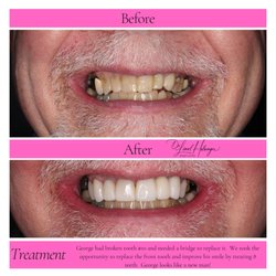 Restorative and cosmetic dental case featuring a dental bridge and front tooth restoration to improve smile function and appe...