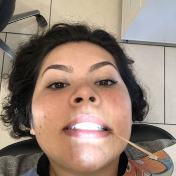Joy Dental - Before cavity filling - Cosmetic Dentists Near Me - Tijuana, BCN