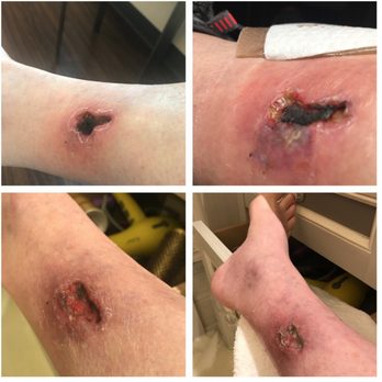 Aspen Medical Care - Dr. Connery glued this wound. Starting top left to bottom right is how it looked a week after it was glued to how it looks today - Family Practice Near Me - Aspen, Colorado Aspen Medical Care - Dr. Connery glued this wound. Starting top left to bottom right is how it looked a week after it was glued to how it looks today - Family Practice Near Me - Aspen, Colorado