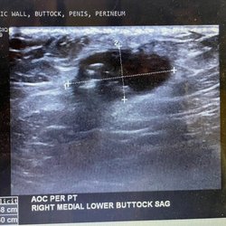 James D Loo, MD - Mass found after nurse practitioner Jackie shamed me for requesting approval for buttock ultra sound