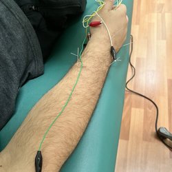 TCM Acupuncture - Doral - Acupuncture and Electric stim of palm/wrist/forearm to help balance my nerve. He is the best early morning in Doral! I feel so much better!