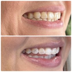 Arch Envy Studio - 1hr whitening & crystal tooth gem