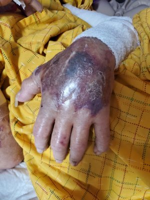 Photo of Regional Medical Center - San Jose, CA, US. His hand is swollen and they bandaged his arm to hide all the purple splotches along his upper arm.