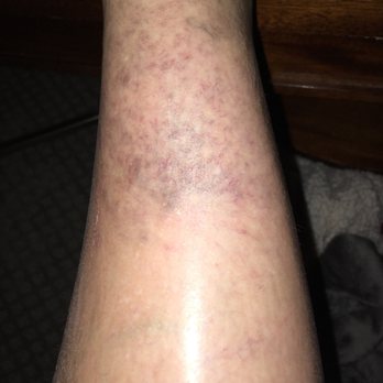 Atlanta Vein Specialists - Looks as if someone has beaten up my legs and huge knots of veins. - Vascular Medicine Near Me - Suwanee, Georgia Atlanta Vein Specialists - Looks as if someone has beaten up my legs and huge knots of veins. - Vascular Medicine Near Me - Suwanee, Georgia