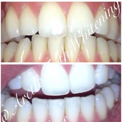 Arctic Teeth Whitening - Before & After
